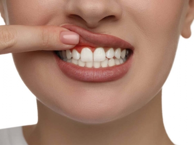 Diş Eti Hastalıkları