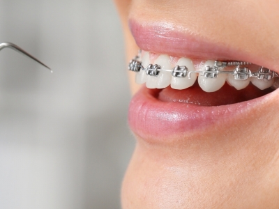 Ortodonti (Diş Teli Tedavisi)